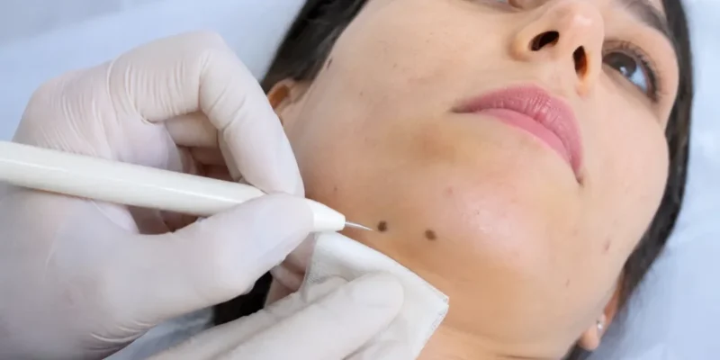 برداشت ضایعات پوستی در رشت