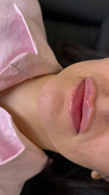 تزریق ژل لب در رشت
